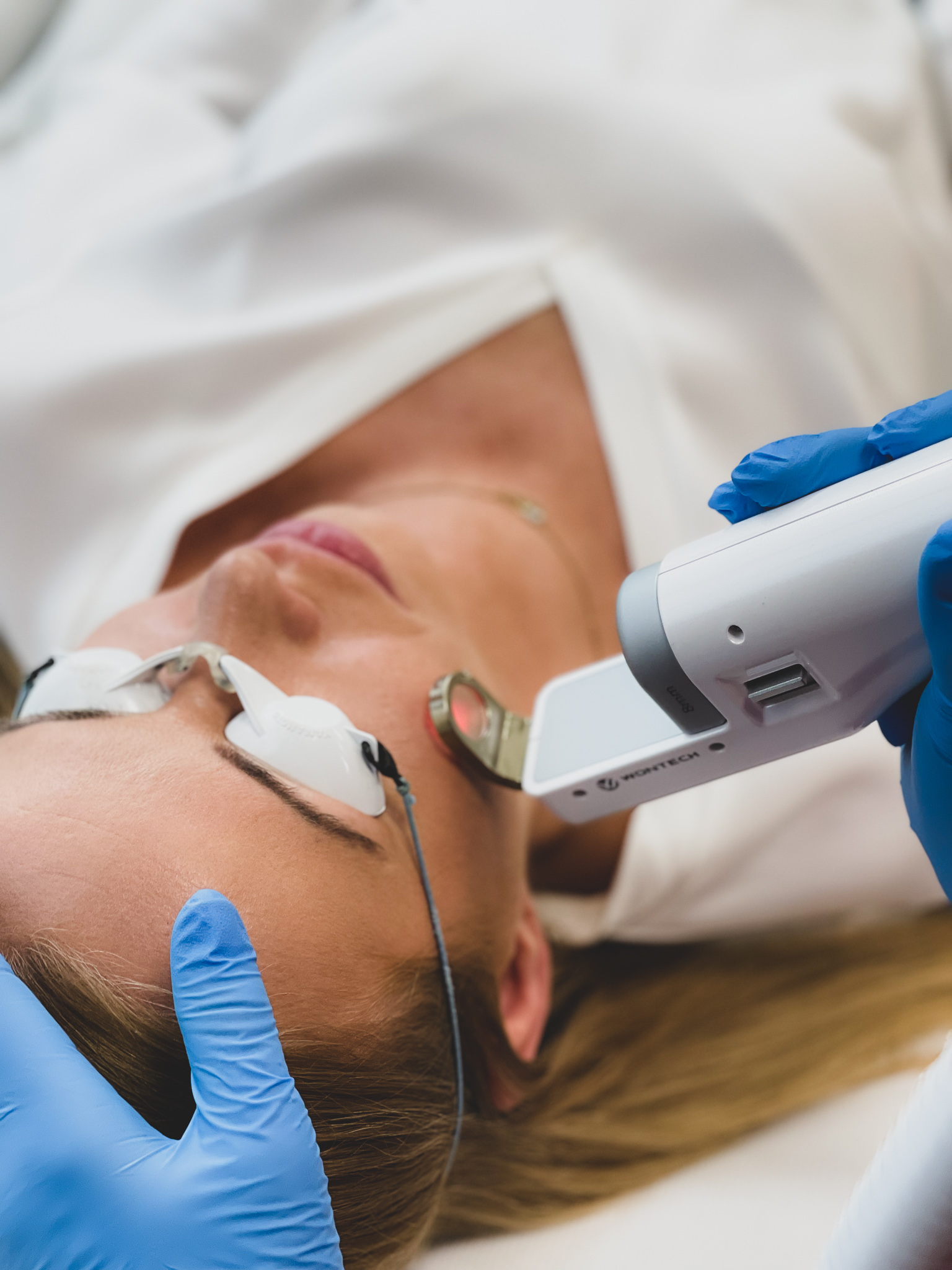 Zdjęcie - V-Laser zamykanie naczynek, leczenie rumienia